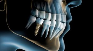 implante Programa Cirurgia Reconstrutiva Bucomaxilofacial